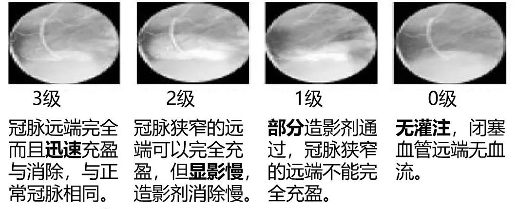 介入医师必看—冠脉造影的判断与评估