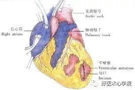 心梗治好了，为什么还要“抗心肌重构”？