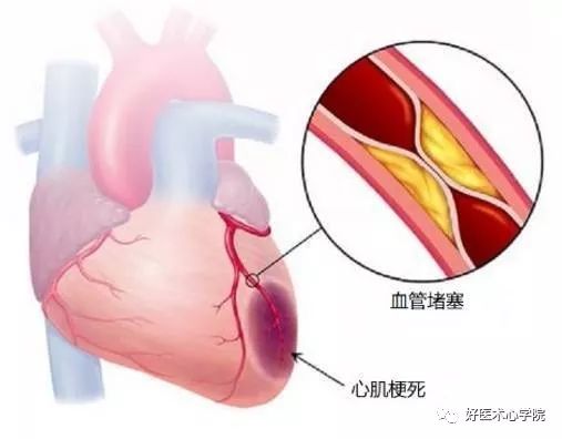 心梗治好了，为什么还要“抗心肌重构”？