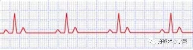 窦性心律，到底是个什么“病”？