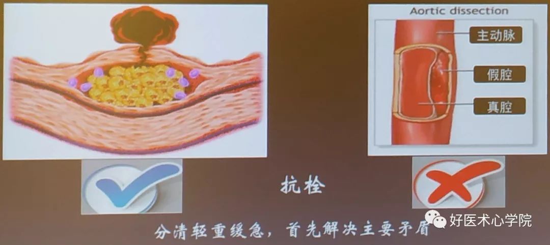 10分钟掌握遇到急性胸痛怎么办