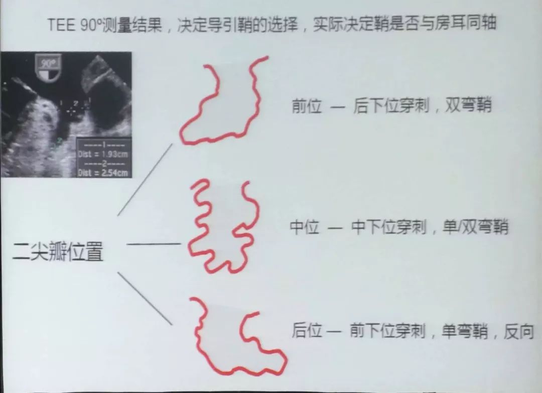 干货！左心耳封堵术实操技巧