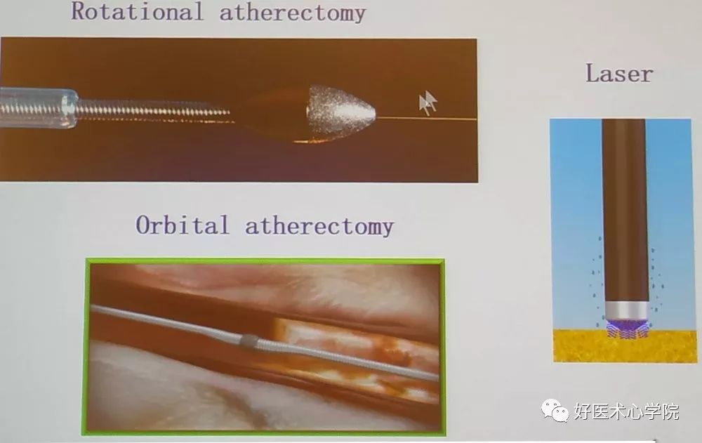 左主干合并严重钙化介入技巧实用攻略