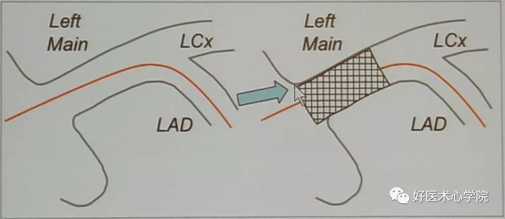 左主干合并严重钙化介入技巧实用攻略