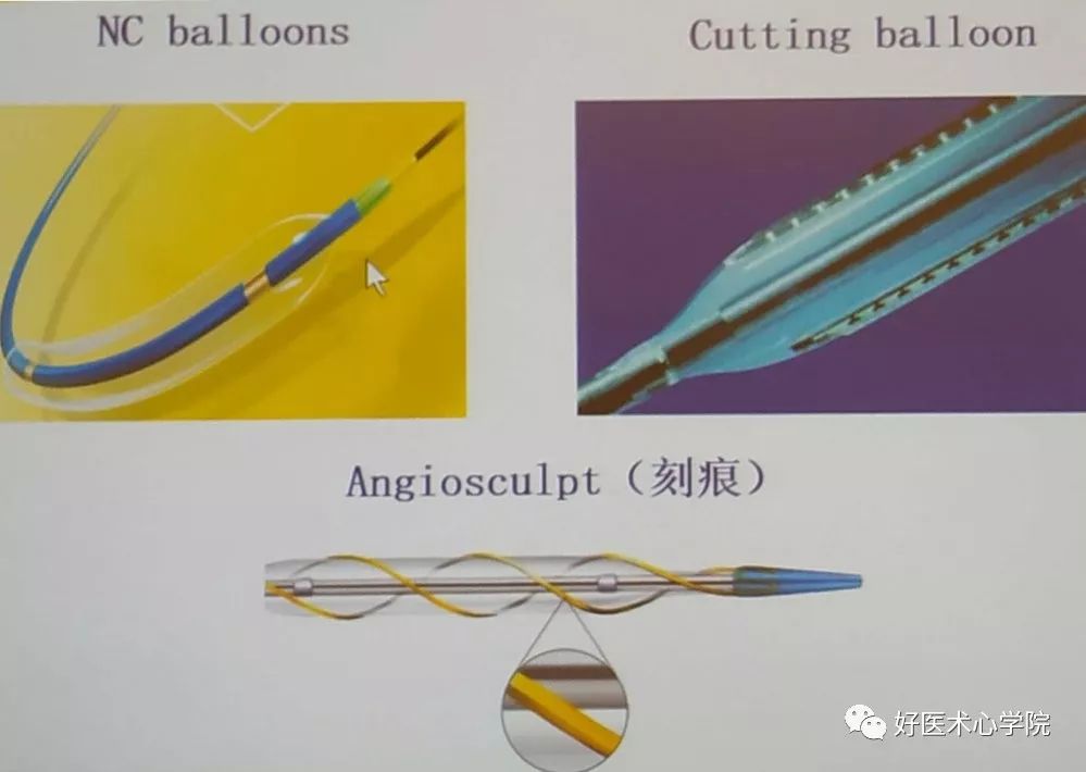 左主干合并严重钙化介入技巧实用攻略