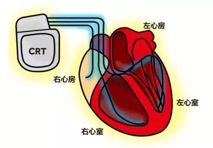 心力衰竭药物治疗效果差，还有办法吗？