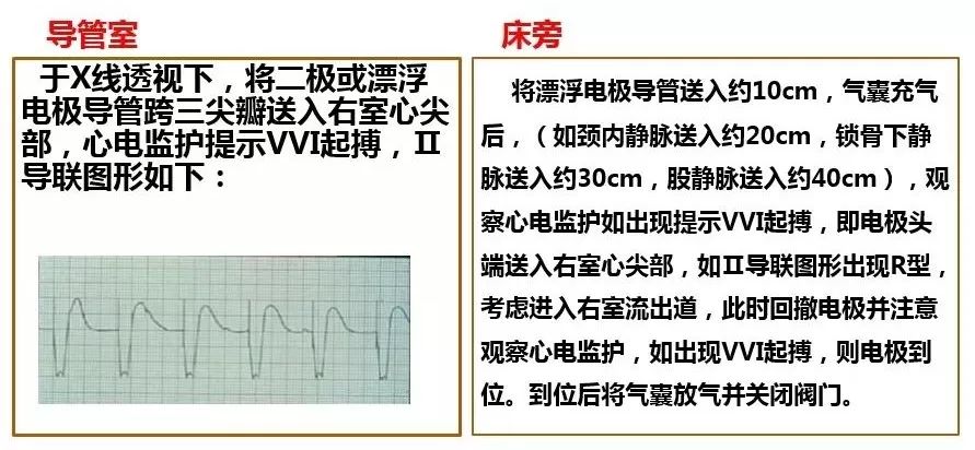 植入临时起搏器方法与技巧