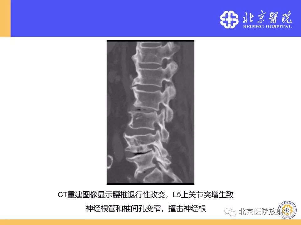 椎管狭窄的影像学检查，都在这篇文章里！