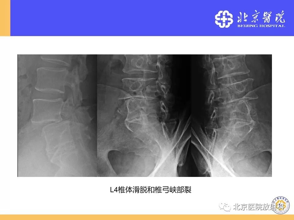 椎管狭窄的影像学检查，都在这篇文章里！