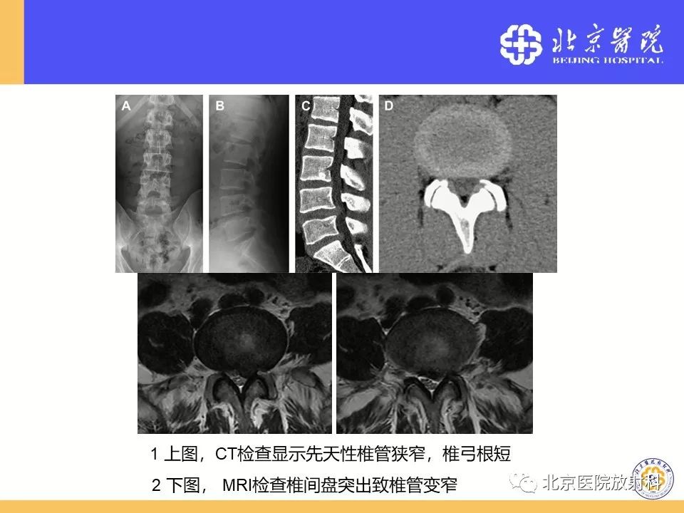 椎管狭窄的影像学检查，都在这篇文章里！