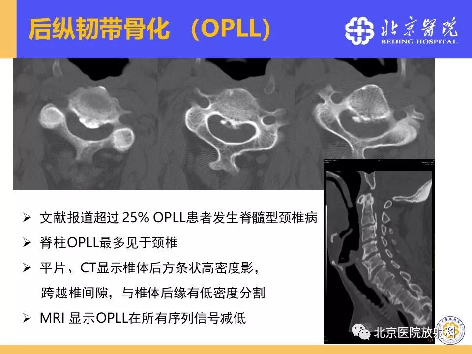 椎管狭窄的影像学检查，都在这篇文章里！