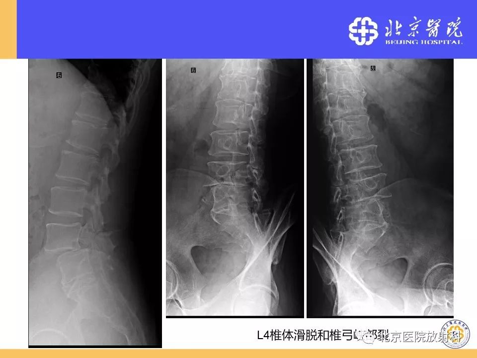 椎管狭窄的影像学检查，都在这篇文章里！