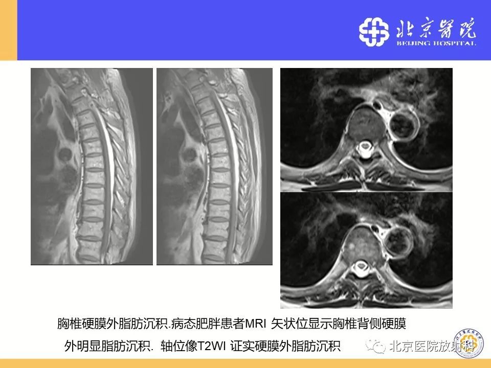 椎管狭窄的影像学检查，都在这篇文章里！