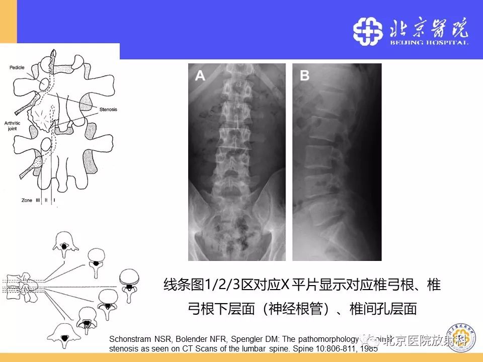 椎管狭窄的影像学检查，都在这篇文章里！