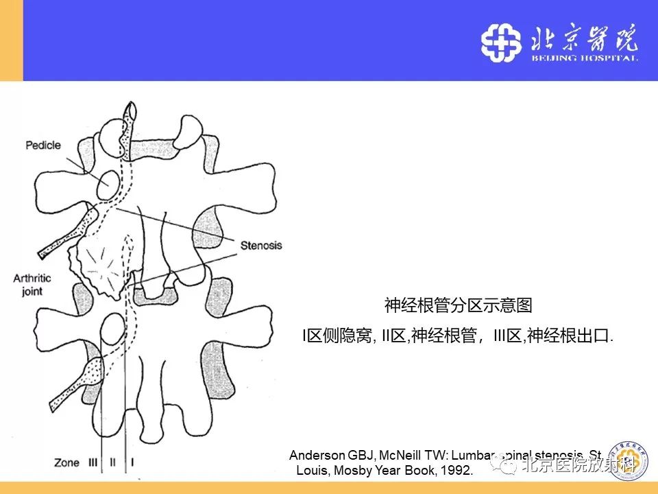 椎管狭窄的影像学检查，都在这篇文章里！