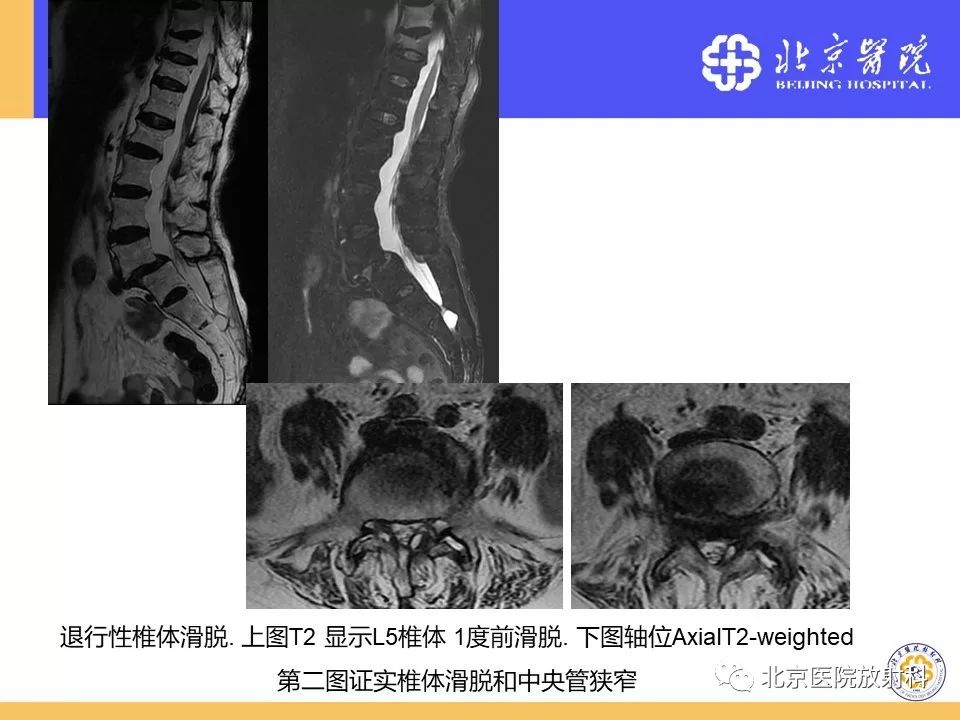 椎管狭窄的影像学检查，都在这篇文章里！