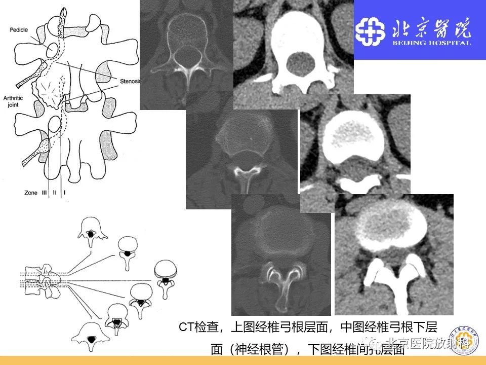 椎管狭窄的影像学检查，都在这篇文章里！