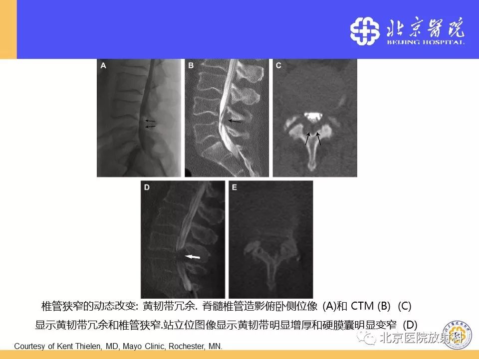 椎管狭窄的影像学检查，都在这篇文章里！