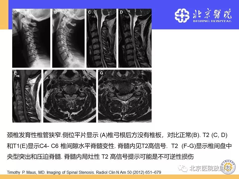 椎管狭窄的影像学检查，都在这篇文章里！