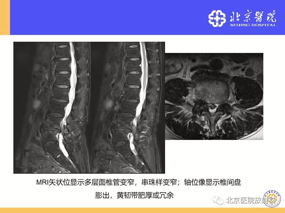 椎管狭窄的影像学检查，都在这篇文章里！