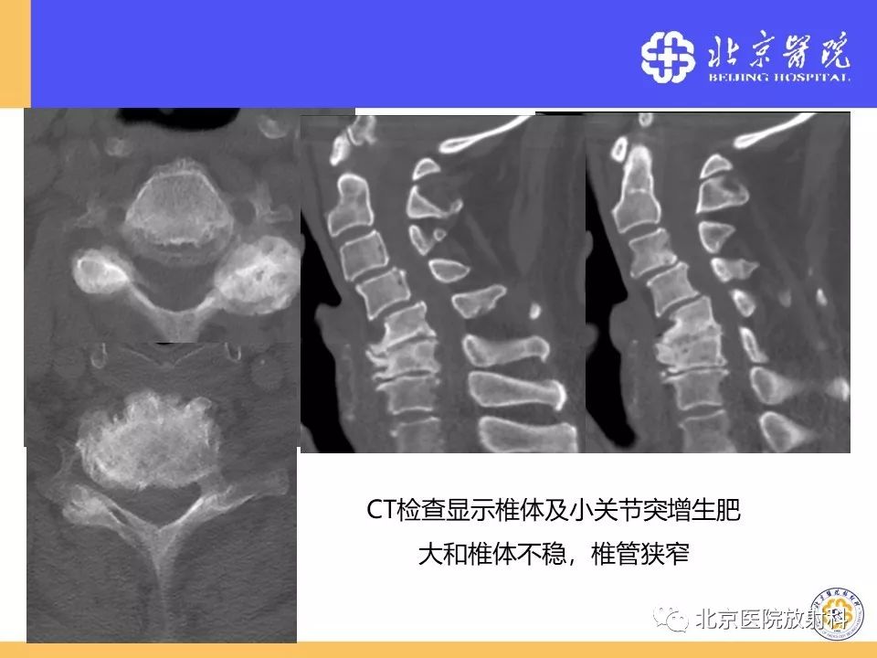 椎管狭窄的影像学检查，都在这篇文章里！