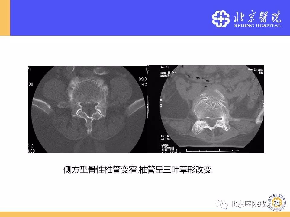 椎管狭窄的影像学检查，都在这篇文章里！