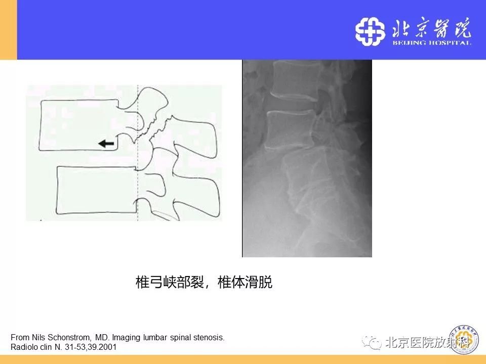 椎管狭窄的影像学检查，都在这篇文章里！