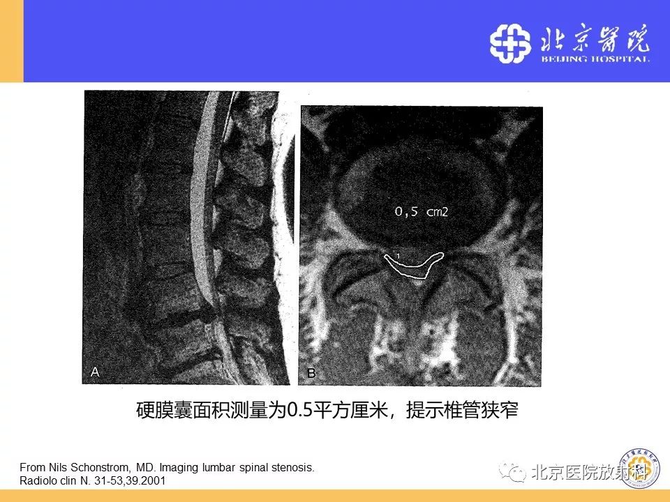 椎管狭窄的影像学检查，都在这篇文章里！