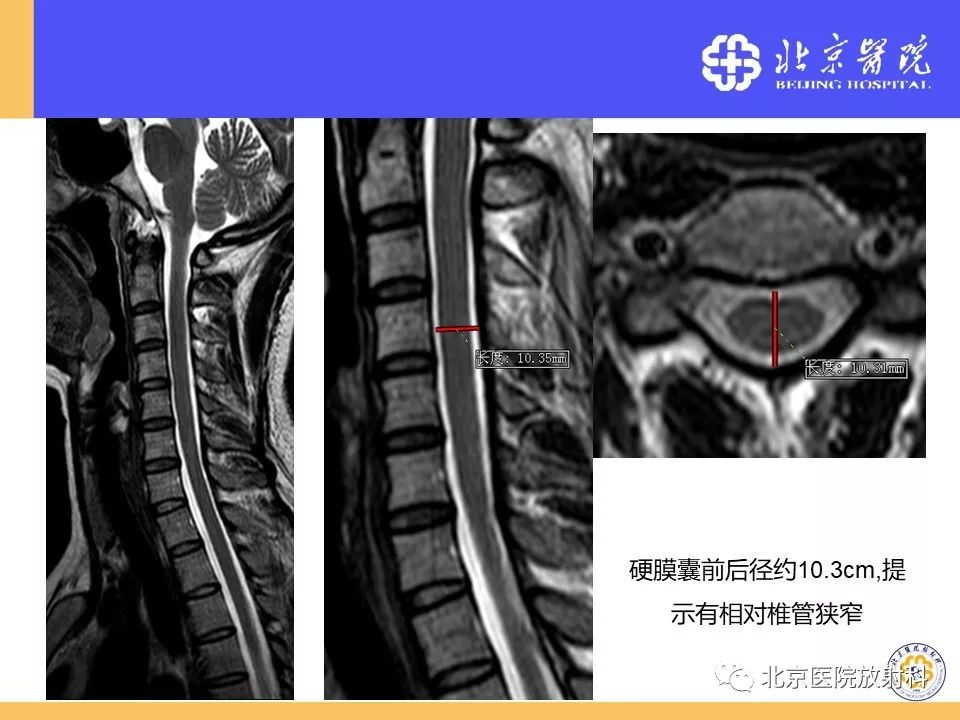 椎管狭窄的影像学检查，都在这篇文章里！