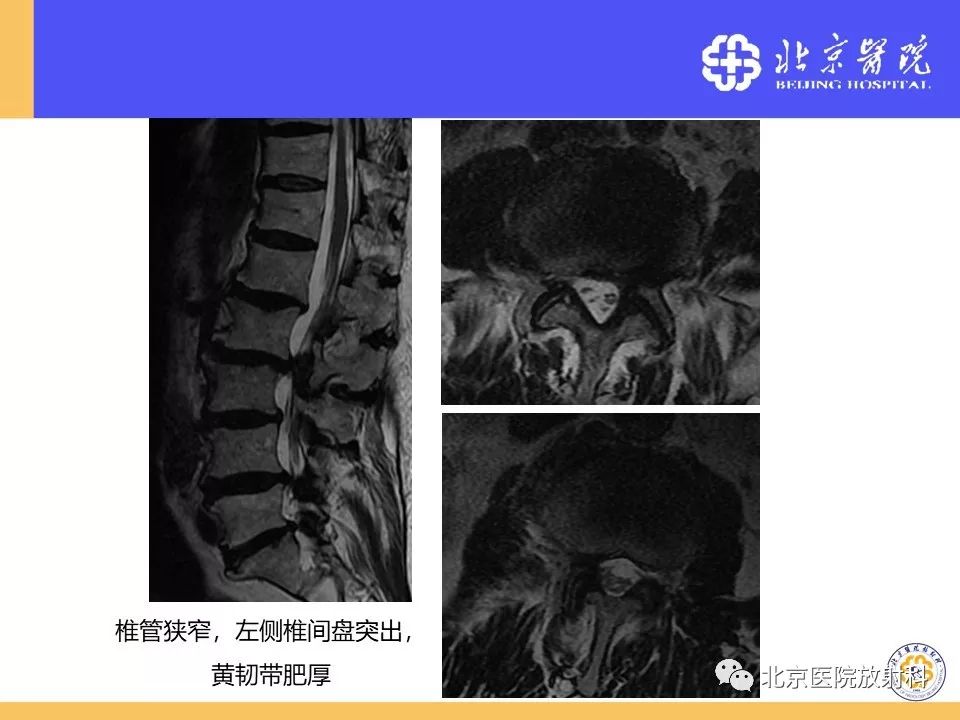 椎管狭窄的影像学检查，都在这篇文章里！