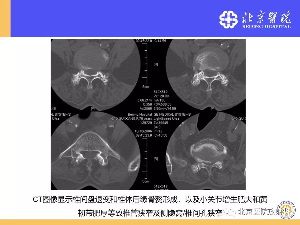 椎管狭窄的影像学检查，都在这篇文章里！