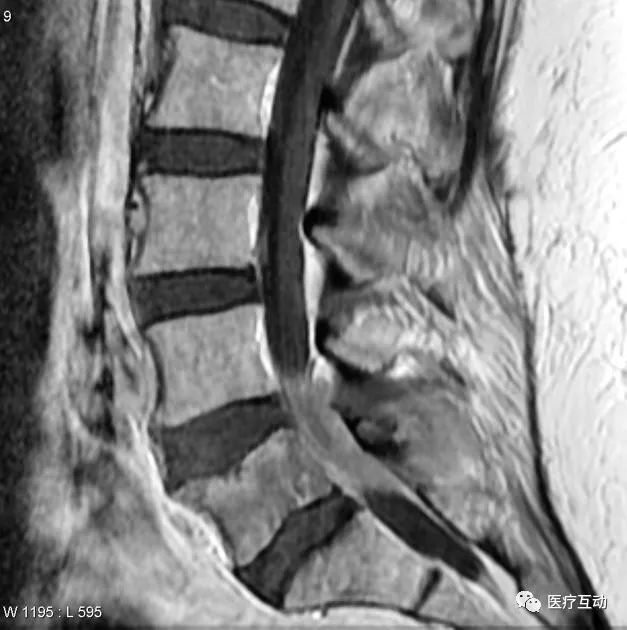 值得一看！脊柱上可能提示系统性病变的影像学改变图谱