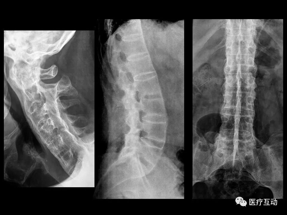 值得一看！脊柱上可能提示系统性病变的影像学改变图谱