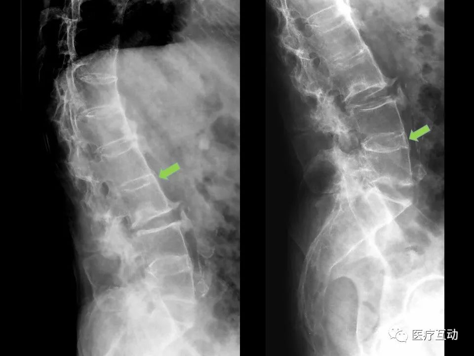 值得一看！脊柱上可能提示系统性病变的影像学改变图谱