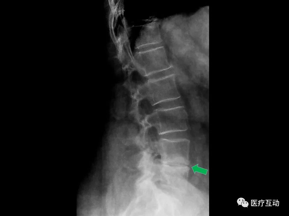 值得一看！脊柱上可能提示系统性病变的影像学改变图谱