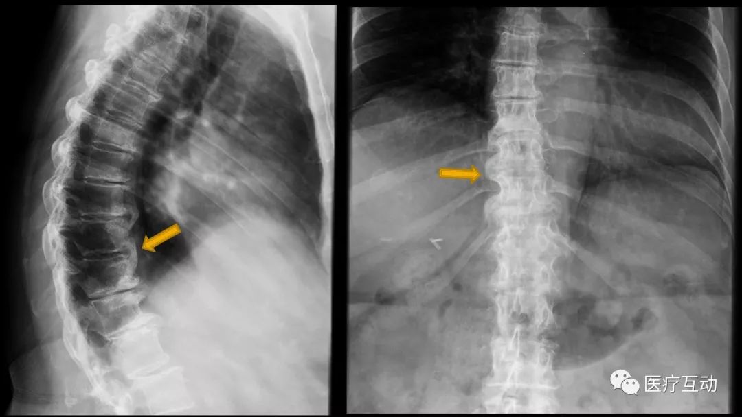 值得一看！脊柱上可能提示系统性病变的影像学改变图谱