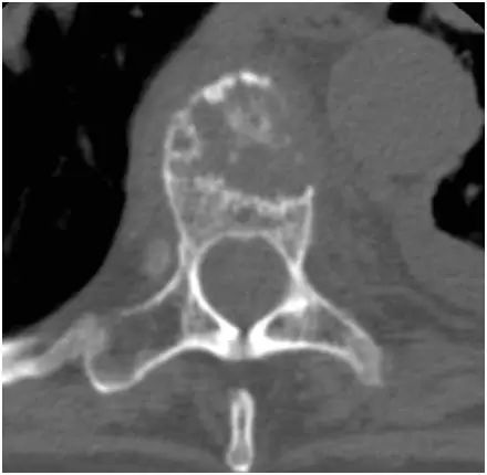 癌症患者脊柱疼痛的鉴别诊断，你都掌握了吗？