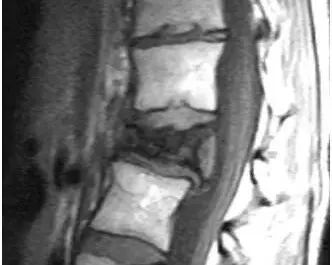 癌症患者脊柱疼痛的鉴别诊断，你都掌握了吗？