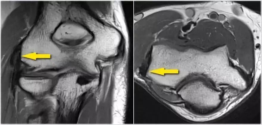 肘关节常见疾病的MRI影像图谱，赶快收藏！