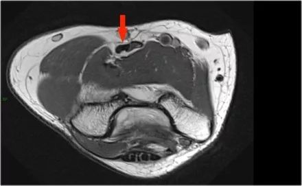 肘关节常见疾病的MRI影像图谱，赶快收藏！