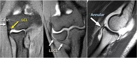 肘关节常见疾病的MRI影像图谱，赶快收藏！