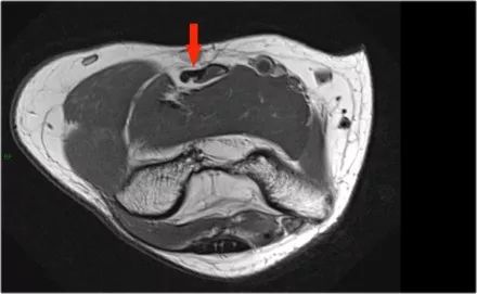 肘关节常见疾病的MRI影像图谱，赶快收藏！