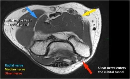 肘关节常见疾病的MRI影像图谱，赶快收藏！