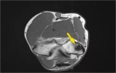 肘关节常见疾病的MRI影像图谱，赶快收藏！