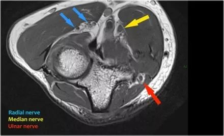 肘关节常见疾病的MRI影像图谱，赶快收藏！