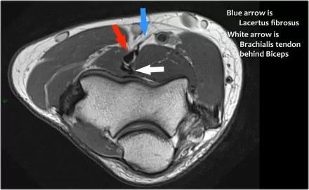 肘关节常见疾病的MRI影像图谱，赶快收藏！