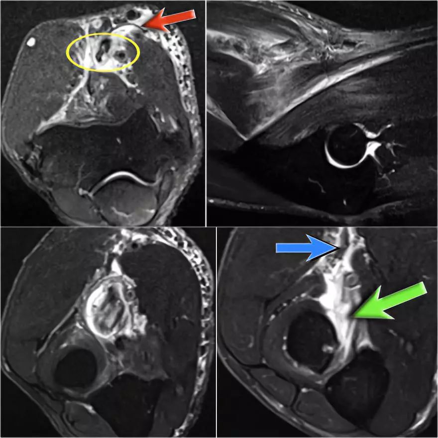肘关节常见疾病的MRI影像图谱，赶快收藏！