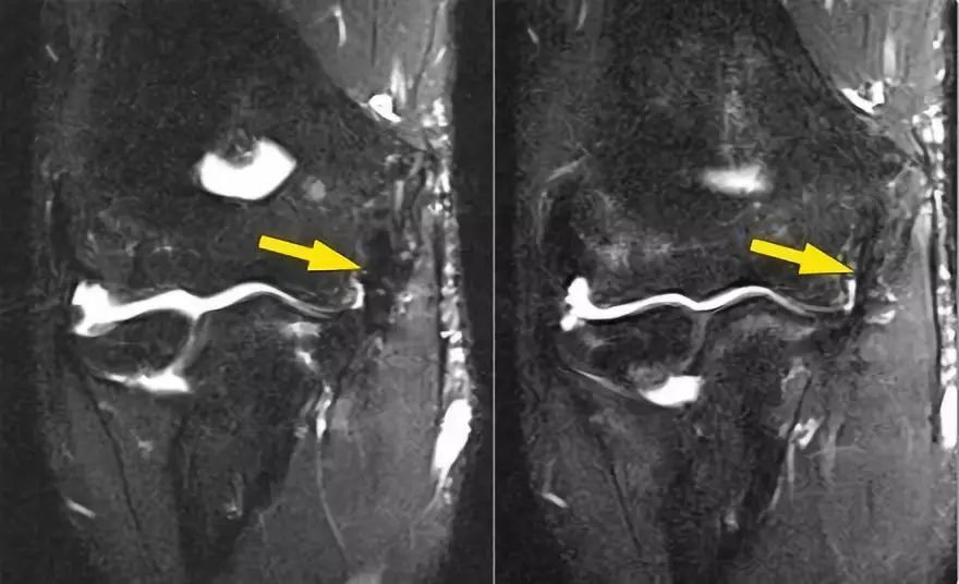 肘关节常见疾病的MRI影像图谱，赶快收藏！