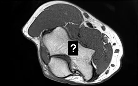 肘关节常见疾病的MRI影像图谱，赶快收藏！