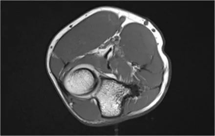 肘关节常见疾病的MRI影像图谱，赶快收藏！
